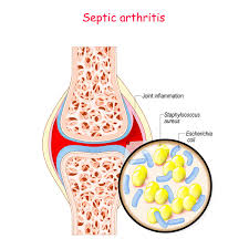 Image result for Septic Joint