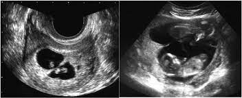 Many variations on the rainbow flag exist, including incorporating other lgbt symbols like the triangle or lambda. Lambda Sign Or Twin Peak Sign In 6 Weeks Of Gestation Left And 13 Download Scientific Diagram