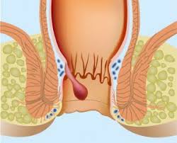 Image result for hemoroid human