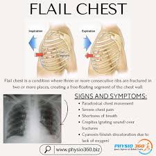 Image result for Flail Chest