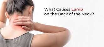 Name for hump.in back.of nevck : 21 Dowagers Hump Ideas Dowager Hump Posture Exercises Hump