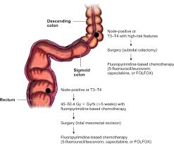 By the time you do feel symptoms, the cancer may be more advanced. Cancers Of The Colon And Rectum Identical Or Fraternal Twins Cancer Discovery