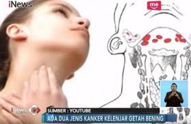 Dikutip dari medical news today , banyak kondisi yang menyebabkan kelenjar getah bening membengkak, terutama kelenjar di kepala dan leher. Kenali Ciri Ciri Kanker Getah Bening