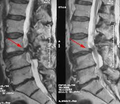 Vor allem sollte vor der anfertigung von einem mrt dringend. Prof Dr Christian Woiciechowsky Neurochirurgie Berlin Wirbelgleiten