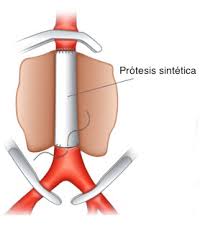 Endovascular Es