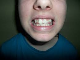 Welche gründe sprechen für eine korrektur der zahnstellung? Absolut Ehrlich Abenteuer Zahnspange Episode 1