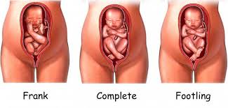 Turning Breech Babies Breech Babies Turn A Breech Baby Baby Massage