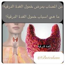 من المصاب بمرض خمول الغدة الدرقية هذا المرض قد يأتي في اي عمر لكن النساء تصاب بهذا المرض اكثر من الرجال ما هي اسباب خمول الغدة ال Health Tips Health Thyroid