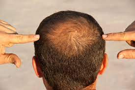 Salve,.premetto che ho 33 anni e ho sempre avuto folti capelli e con ricrescita veloce.in questa quarantena mi sono fatto una piccola ferita nel. Perdita Di Capelli Attenzione Puo Essere Il Sintomo Di Una Terrificante Malattia Libero Quotidiano