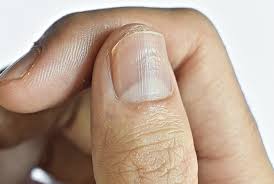 A bruised fingernail is something you have to take care of carefully. What Do Vertical Ridges On Fingernails Mean Organic Olivia