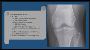 Image result for Segond Fracture