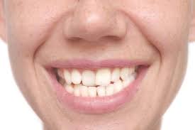 ✅ speedbrackets, keramikbrackets, selbstligierende oder kassenbrackets? Einzelner Schiefer Zahn Veneers Oder Zahnspange Jameda
