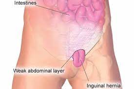 Inguinal Hernia Introduction