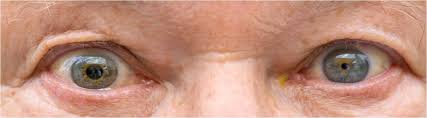 Image result for Pupillary Paralysis