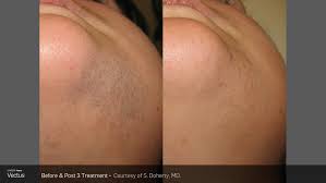 The chromophore (target) for laser or ipl hair removal is melanin. Everything You Need To Know About Laser Hair Removal In Fort Worth Tx The Retreat Medical Spa