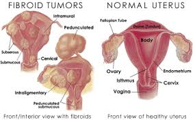 Less than one in a thousand cases of fibroids develop into cancer 9). Treatment Of Fibroid Tumors Stephen Wells M D