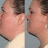 It's time to say goodbye to the hair on your face laser hair removal. 1
