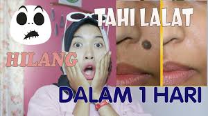 Bagi siapa saja yang tidak menyukai tahi lalat bisa dihilangkan dengan mudah. Cara Menghilangkan Tahi Lalat Dalam 1 Hari 100 Work How To Remove Skin Tag Soniashsp Youtube