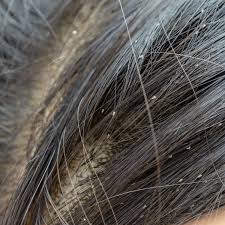 Over 21 million women and 35 million men in america suffer from hair loss. Getting Rid Of Bugs In Hair Thriftyfun