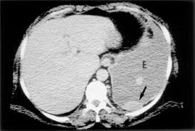 This review is based on a presentation given by angela levy and adapted for the radiology assistant by robin smithuis. Percutaneous Image Guided Cutting Needle Biopsy Of The Pleura In The Diagnosis Of Malignant Mesothelioma Chest