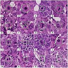 It is often disregarded but could be a sign of inflammatory breast cancer. Breast Cancer Classification Wikipedia