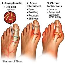 Image result for gout symptoms toe