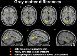 Frontiers Brain Structure Alterations In Respect To Tobacco Consumption And Nicotine Dependence A Comparative Voxel Based Morphometry Study Frontiers In Neuroanatomy