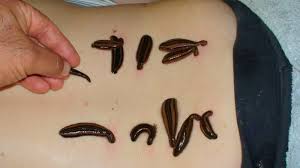 Uses And Benefits Of Leech Therapy Dental Problems Treat Cancer Leech