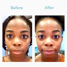 Here are 11 easy tips to get an even skin tone fast and naturally. The Best Hyperpigmentation Treatment For Black Skin Mdacne