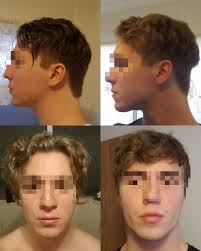 Check spelling or type a new query. Sol W Brah On Twitter Evidence For Mewing In A Study Conducted In 2014 Published In The Korean Journal Of Orthodontics The Corrective Tongue Posture Technique Was Able To Correct