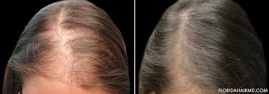 With baldness, stem cells are present on the scalp, but they are deficient. Stem Cell Hair Restoration Tampa Stem Cell Hair Therapy