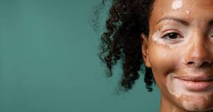 Image result for robert zaruba vitiligo