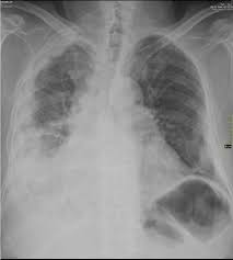 We did not find results for: Mesothelioma Mesothelioma Radiology Pulmonology