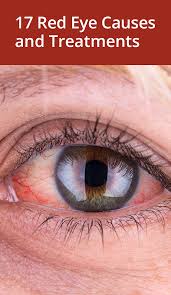 I was just standing on my porch, looking at the woods. 19 Causes And Treatments For Red Eyes Red Eyes Remedy Red Eye Treatment Red Eye Causes