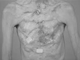 You can verify if a breast implant is licensed by: The History Of Biomaterials Used For Breast Augmentation Sciencedirect