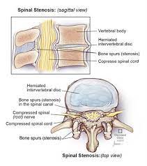 Spinal Stenosis What Is It Symptoms Causes Treatment Surgery