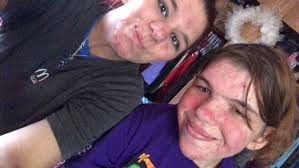 This is my sister she's had NF 1 but so far so good nothing serious let's  pray nothing gets worse as she gets older. She's 23 y/o works hard and she  spoils