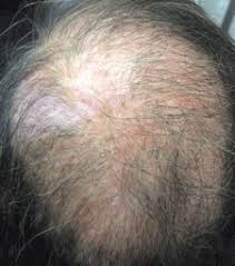 Image result for Tinea Capitis