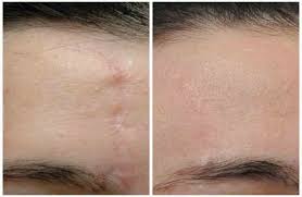 More aesthetically pleasing scars match the surrounding skin in color, texture, distensibility patient characteristics also play a large factor in scarring, as do the quality of closure and cleanliness of the revision of unsightly scars is a frequent concern to surgical patients. Scar Revision Surgery In India Cost Hospitals Doctor
