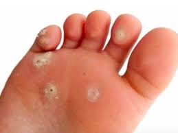 Maybe you would like to learn more about one of these? 10 Astuces Pour Vous Debarrasser Des Ampoules Et Des Cors