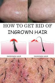 It can be used to get effectively rid of ingrown hair fast since it gets rid of dead skin on the skins top layer. Every Woman Wants Perfect Smooth Legs Without Any Ingrown Hairs Read What S Causing Ingrown Hairs And How Ingrown Hair Ingrown Facial Hair Ingrown Hair Bikini
