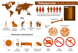 We did not find results for: Osteoporosis What S The Big Deal Mile High Spine Pain Center