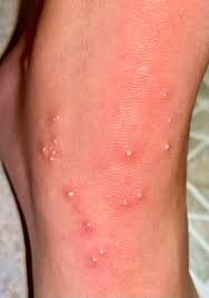 Image result for Fire Ant Sting