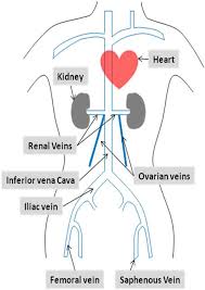 Pelvic Venous Congestion Syndrome Bsir