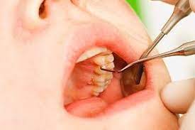 Secondly if the trauma was light and the tooth is slightly wobbly then you may want to wait two weeks. How To Tighten Loose Teeth Naturally Top Home Remedies For Loose Tooth Repair Loose Tooth Tooth Replacement Tooth Repair