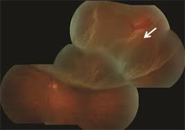 The purpose of this study was to evaluate the economic landscape of rop screening and treatment among pediatric ophthalmologists in the united states. Retinal Detachment The American Society Of Retina Specialists