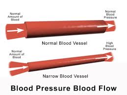 Symptoms of hypertension (high blood pressure) are usually silent. Can Maternal High Blood Pressure Cause Hie And Cerebral Palsy