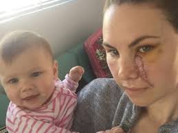 Here, we offer their simple tips to prevent damage to your child's skin that could lead to skin cancer. Skin Cancer Mum Of Two Terri Hahipene S Skin Check Warning Could Have Lost An Eye 9honey