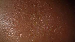 Image result for Sunburn