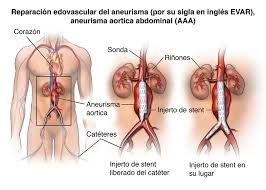 La aorta transporta la sangre rica en oxígeno desde el los aneurismas pueden formarse en cualquier sección de la aorta, pero son más comunes en la zona del abdomen ( aneurisma aórtico abdominal ). Abdominal Aortic Aneurysm
